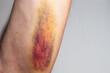 A large colored bruise on the skin of the inside of a man's shoulder. Medical concept