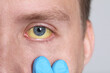 Doctor checking man with yellow eyes on light background, closeup. Symptom of hepatitis