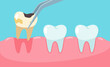 Pencabutan gigi berlubang vektor. gigi tidak sehat.