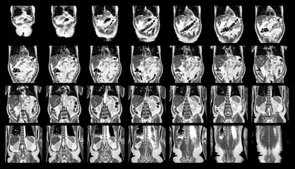 Magnetic resonance imaging (MRI)OF UPPER ABDOMEN of a patient who has suspected mass-forming hilar cholangiocarcinoma Coronal view science and education.Medical Technology and Science concept.