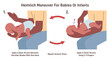 Choking first aid. Heimlich maneuver procedure to remove a foreign
