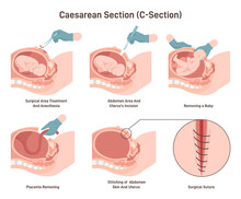 Stages Of Baby Birth With Caesarean Section. Fetus Position During