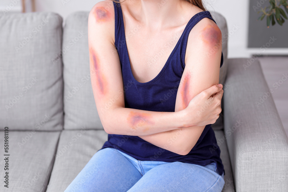 Young woman with bruised arms sitting on sofa at home