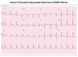 Acute ST-Elevation Myocardial Infarction (STEMI) Inferior - ECG Paper 12 Lead