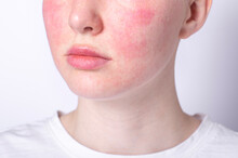 Rosacea Couperose Redness Skin, Red Spots On Cheeks, Young Woman With Sensitive Skin, Patient Face Close-up 