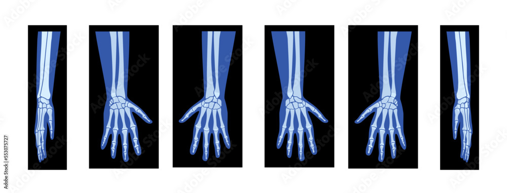 Stock-Vektorgrafik „Set of X-Ray Hands with Radius, Ulna Skeleton Human ...
