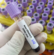 Blood Sample positive for Avian Influenza type A (H3N8) virus test, avian influenza virus (AIV), avian flu or bird flu.