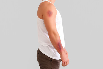 Man with bruises on arm against light background