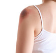 © Pixel-Shot - Young woman with bruised shoulder on white background, closeup