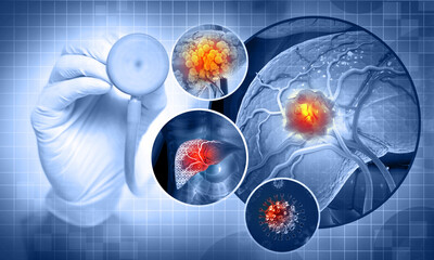 Liver cancer, Hepatocellular Carcinoma (HCC), conditions, causes and treatment. 3d illustration