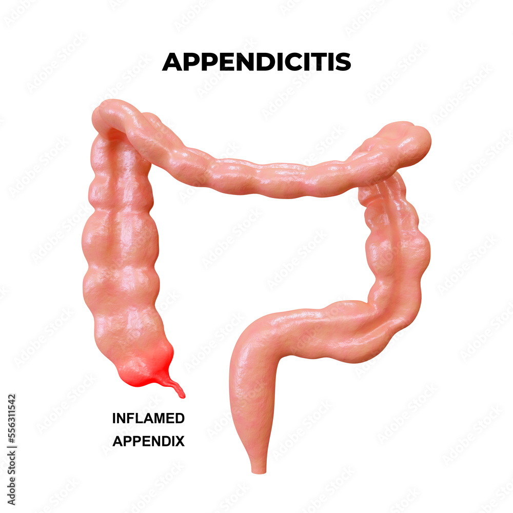 Appendicitis consists of inflammation and infection of the appendix, a ...