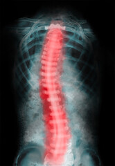 X-ray of human spine showing curvature. Patient suffering from scoliosis