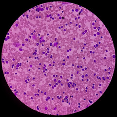 Poster - Acute leukemia (Probably ALL). Anisocytic anisochromia, increased lymphocytes, reduced platelets. Acute lymphoblastic leukemia.