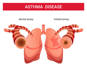 Asthma vector illustration ,asthma infographic