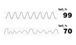 normal oxygen saturation waveform with poor baseline waveform monitoring
