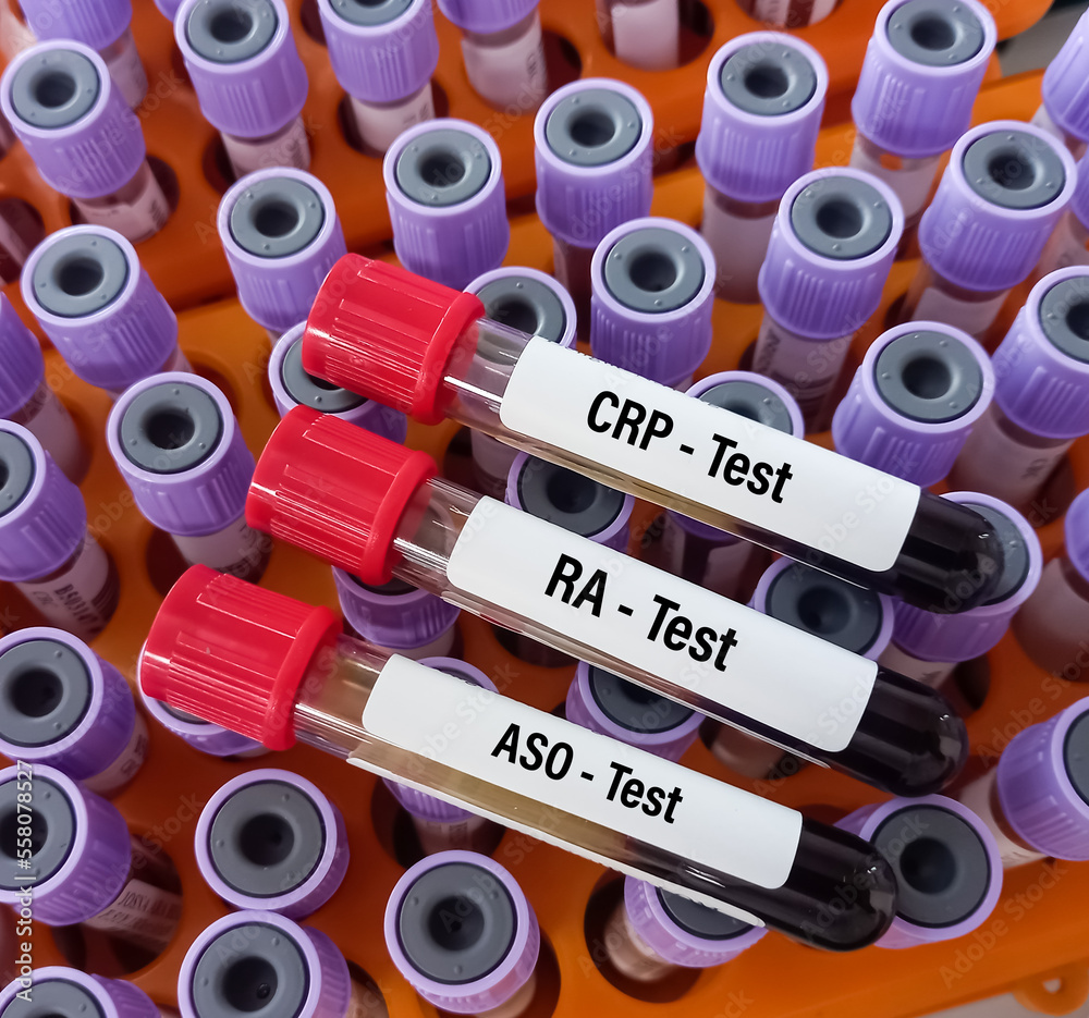 Blood samples for CRP,RA and ASO test, Serological test for inflammation. Rheumatoid arthritis.
