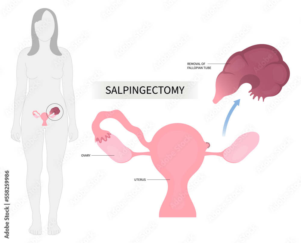 Female uterus biopsy surgical ovary tubal cyst pelvic cancer tumor ...
