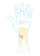 Avascular necrosis hand displacement break painful radial dislocated fall onto an outstretched closed fragment of dorsal Ulna Extra Intra articular and De quervain's proximal by car pole anatomy