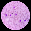 Microscopic finding, Neutrophilic leukocytosis with thrombocytosis, increase total count of White blood cell and increase number of neutrophils.