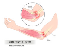 Golfer's Elbow Pain Sport Injury In Pronation Wrist Common Radial Flexion Rotator Cuff Of Cozen's With Mill's Test Nerve And Tricep Extensor Carpi Radialis Brevis Muscle Rupture