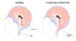 Anatomy of brain with Chiari malformation