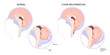 Anatomy of brain cancer tumor bleeding with Chiari malformation