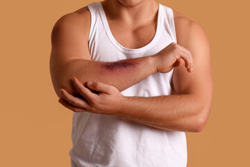 Man with bruise on arm against beige background