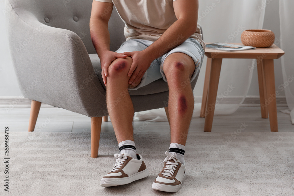 Man with bruises on his body at home