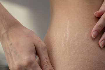 Woman hips with visible stretch marks. Young woman showing Stretch mark scars on her body