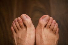 Male Feet Close-up, Toes And Nails, Problem With The Skin Of The Feet And Nails, Care Of The Condition Of The Toes, Fungus And Dry Skin