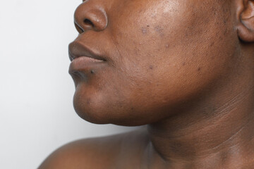 brown skin with dark spots, hyperpigmentation on brown skin, african american woman with skin blemis