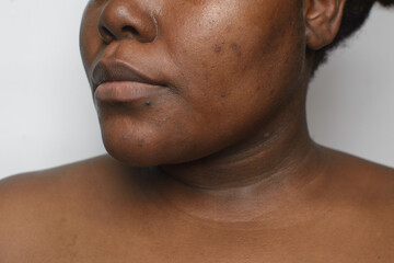 brown skin with dark spots, hyperpigmentation on brown skin, african american woman with skin blemis