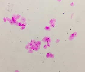 Canvas Print - Photomicrograph of gram stain showing Bacterial Vaginosis