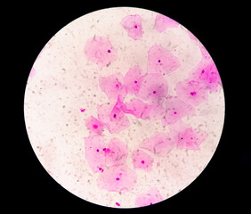 Canvas Print - Photomicrograph of gram stain showing Bacterial Vaginosis