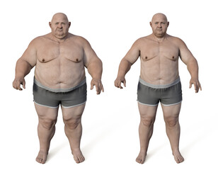 Canvas Print - Obese man before and after gaining weight, 3D illustration. Concept of obesity