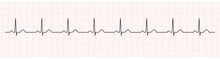 EKG Showing Normal Sinus Rhythm Of Patient 