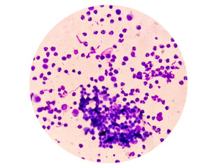 Wall Mural - Synovial Fluid Cytology: Plenty WBC, microscopic examination of synovial fluid, to diagnose arthritis, particularly for septic or crystal-induced arthritis.