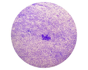 Poster - Synovial Fluid Cytology: Plenty WBC, microscopic examination of synovial fluid, to diagnose arthritis, particularly for septic or crystal-induced arthritis.