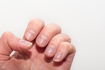 Wall Mural - Close-up of a Caucasian female hand with natural unpolished nails, overgrown cuticles