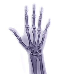 Poster - xray image of both hand ap view isolated on white background for diagnostic rheumatoid.