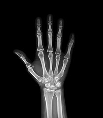 Poster - xray image of both hand ap view isolated on black background for diagnostic rheumatoid.