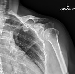 Poster - X-ray of Shoulder joint Grashey view for diagnosis shoulder joint from dislocation or fracture.