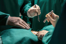 Surgeon Team Using Knife Flashlight Performing Surgery. Surgery People Using Medical Knife And Light To Help Perform. Group Doctor Trying To Cut Open Patient Using Blade And Using Flashlight Looking