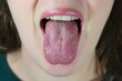 © Tunatura - Oral Candidiasis or Oral trush (Candida albicans), yeast infection on the human tongue.