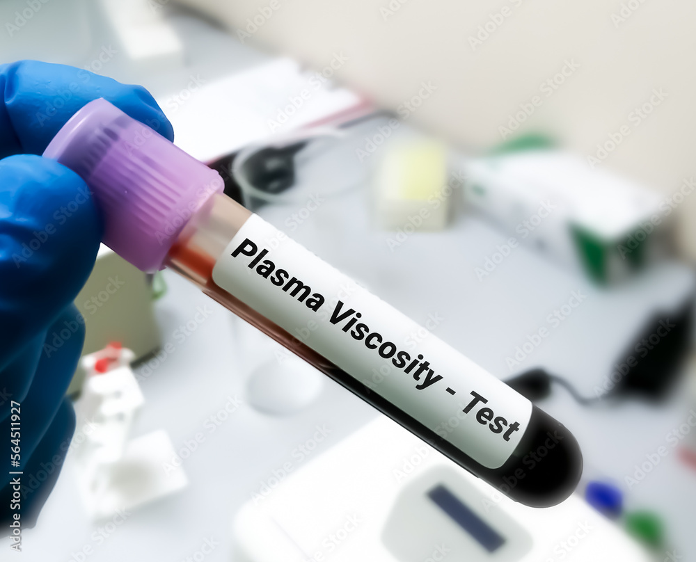 Blood sample for Plasma Viscosity test, Diagnosis for Polymyalgia ...