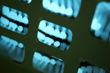 Full Series Mouth X-ray Photo Of Teeth.