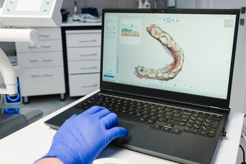 Dental intraoral 3d scanner with teeth on display and laptop in dentist office. Dentistry and health dental care concept. Doctor presenting photo of tooth on 3D tomography. Prosthetic teeth. Closeup.