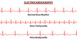© alfa md - Set of ECG Common Abnormalities - Normal Sinus Rhythm - Sinus Tachycardia - Sinus Bradycardia - Vector Medical Illustration