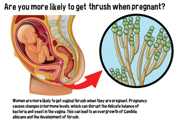 Canvas Print - Vaginal thrush during pregnancy infographic with explanation