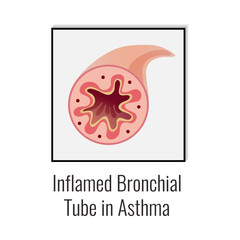 Sticker - Asthma Inflamed Tube Composition